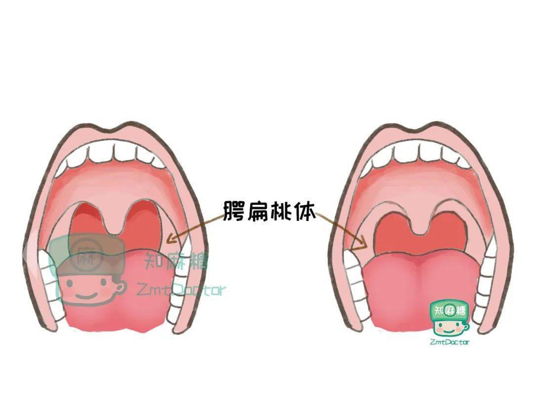 腭舌弓和腭咽弓位置图图片
