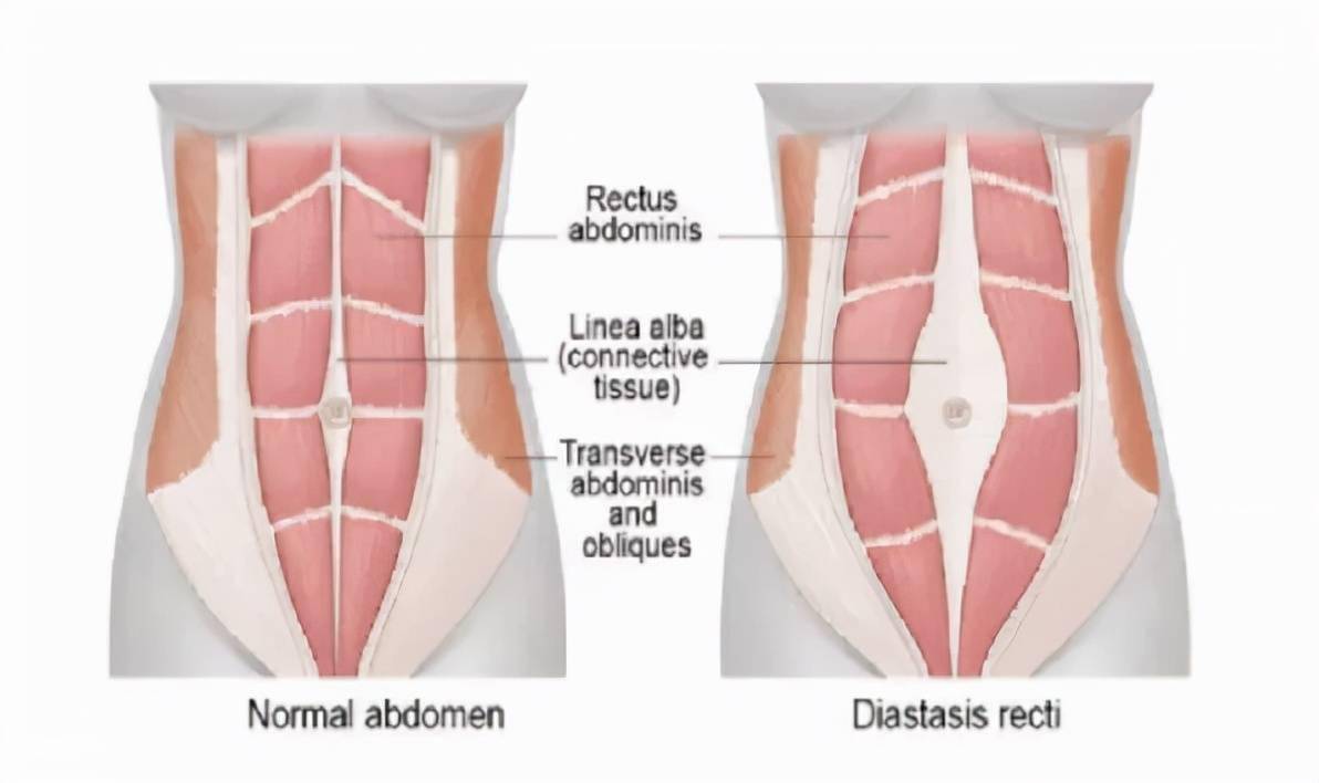 自己怎样测腹直肌分离 e9d059e69f604009b624873c7d63f7d3.jpeg