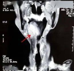 合并|规培医师视角下的多学科协作困难鼻胃管置入
