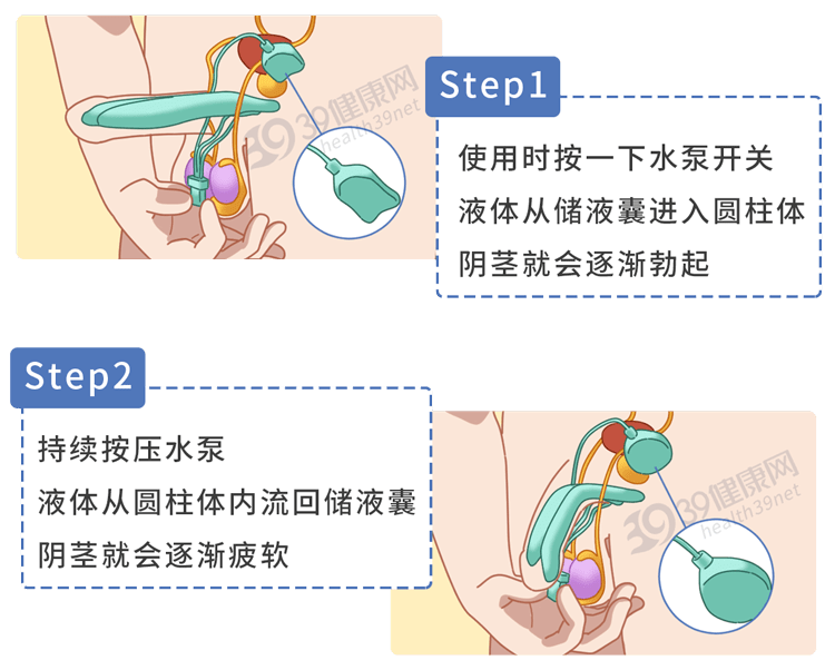 植入人造丁丁?揭秘:阴茎起搏器的效果如何?哪些患者能用?