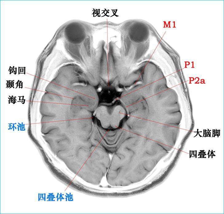 这个高清颅脑断层解剖图谱实在太棒了  磁共振 大体标本