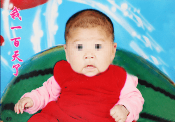 老人|14岁少女皮肤下垂似老人，已在上海一医院做第一期整形手术