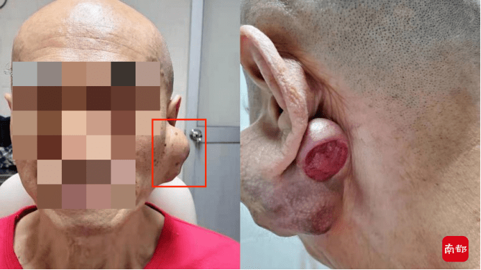 面神经|耳后长“土豆”20多年成恶性肿瘤，医生：发现这个尽早就医