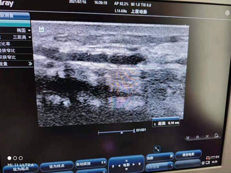 静脉|被医学耽误的“灵魂画手”！内科医生画瘘绘栓重启“生命线”