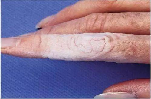 临床护理| 识别marsi风险因素及操作技巧_皮肤