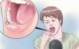 感觉|以为是口腔溃疡，却被诊断为口腔癌？