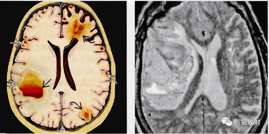 烟雾病,脑淀粉样变性丨影像及临床诊断要点_血管
