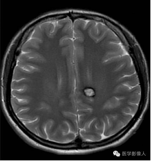 黄素环|脑内T2WI上低信号病变大致分为8大类【总结】