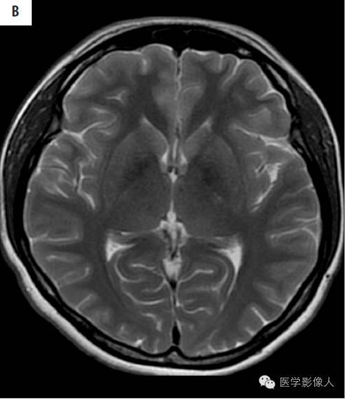 黄素环|脑内T2WI上低信号病变大致分为8大类【总结】