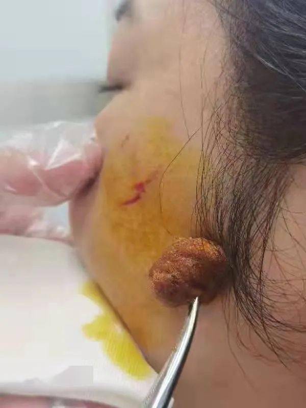 吓人!文山一小区玻璃从天而降,女子脸部被划伤