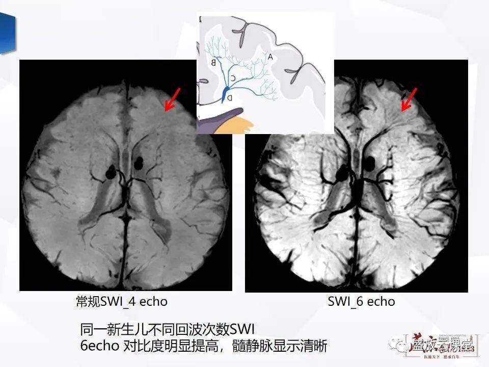 大咖讲堂 | 磁敏感加权成像(swi) 原理及临床应用