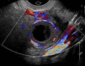 卵巢黃體囊腫周圍的