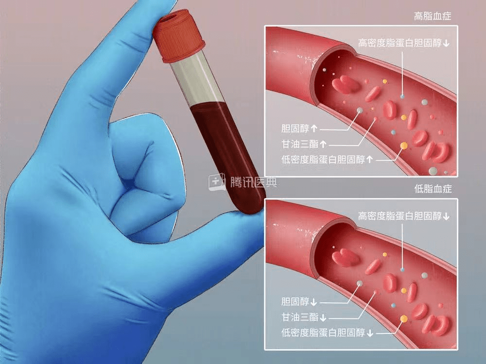 血管|化验单上没有上下箭头，血脂就达标了吗？
