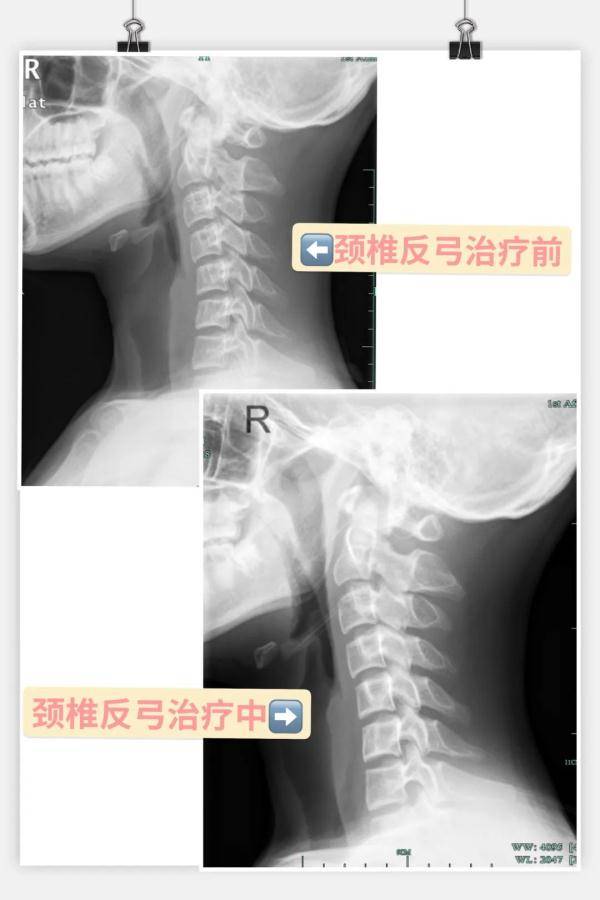 冯智英|“我想拧掉脑袋！”杭州15岁学霸一刷题就头痛欲裂！医生：这个习惯太差了，家长一定要看