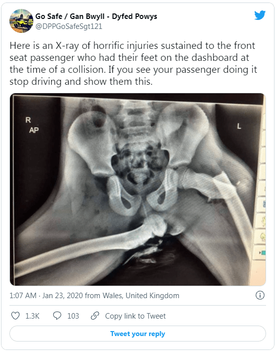 睾丸x光图片