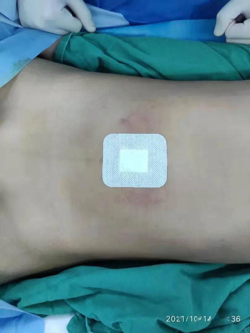 淄博市妇幼保健院开展施行经脐单部位腹腔镜阑尾炎手术