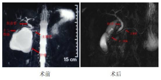 脏器|哈医大一院微创切除巨大肿瘤 胰腺功能“零损失”