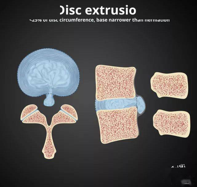 椎間盤膨出突出脫出如何鑑別幾幅圖讓你一目瞭然
