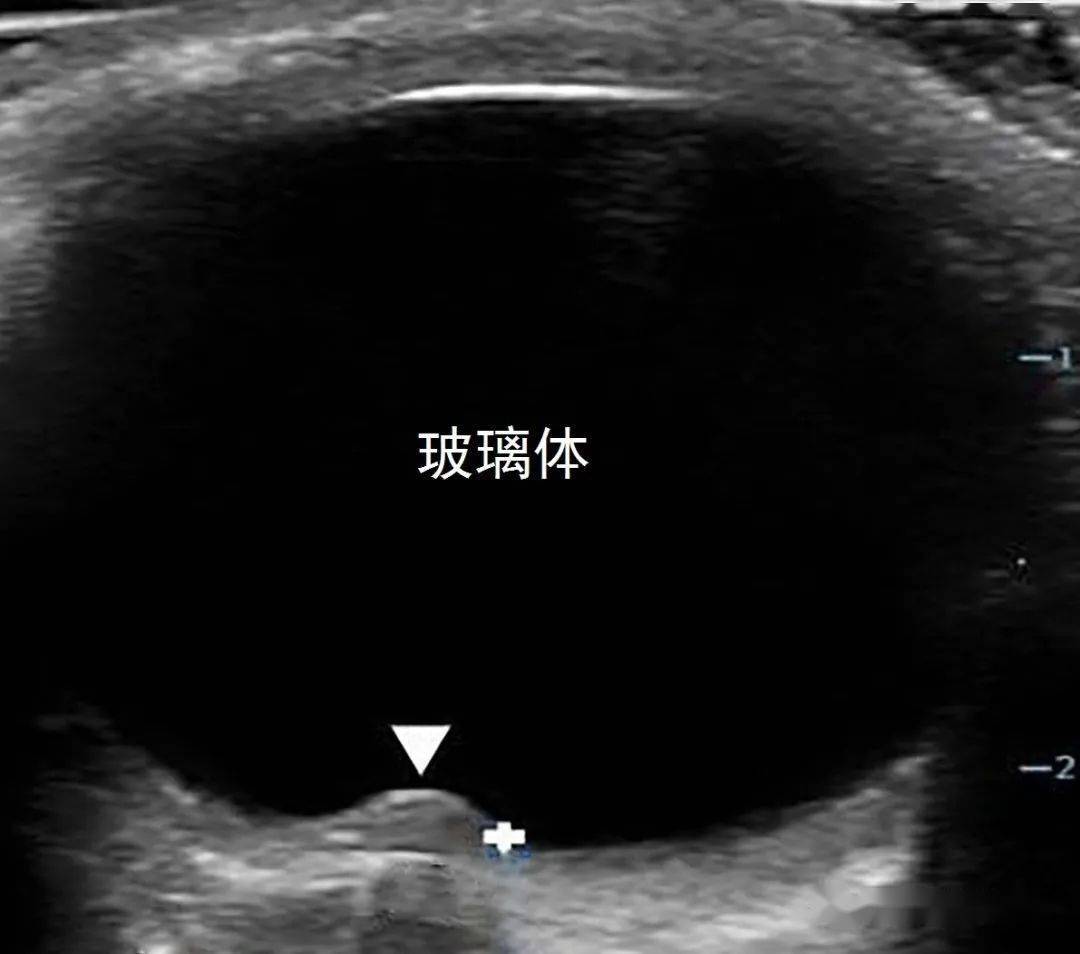 超声征象新月征(crescent sign)