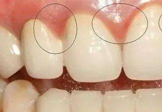 牙龈乳头炎的病因是什么如何治疗