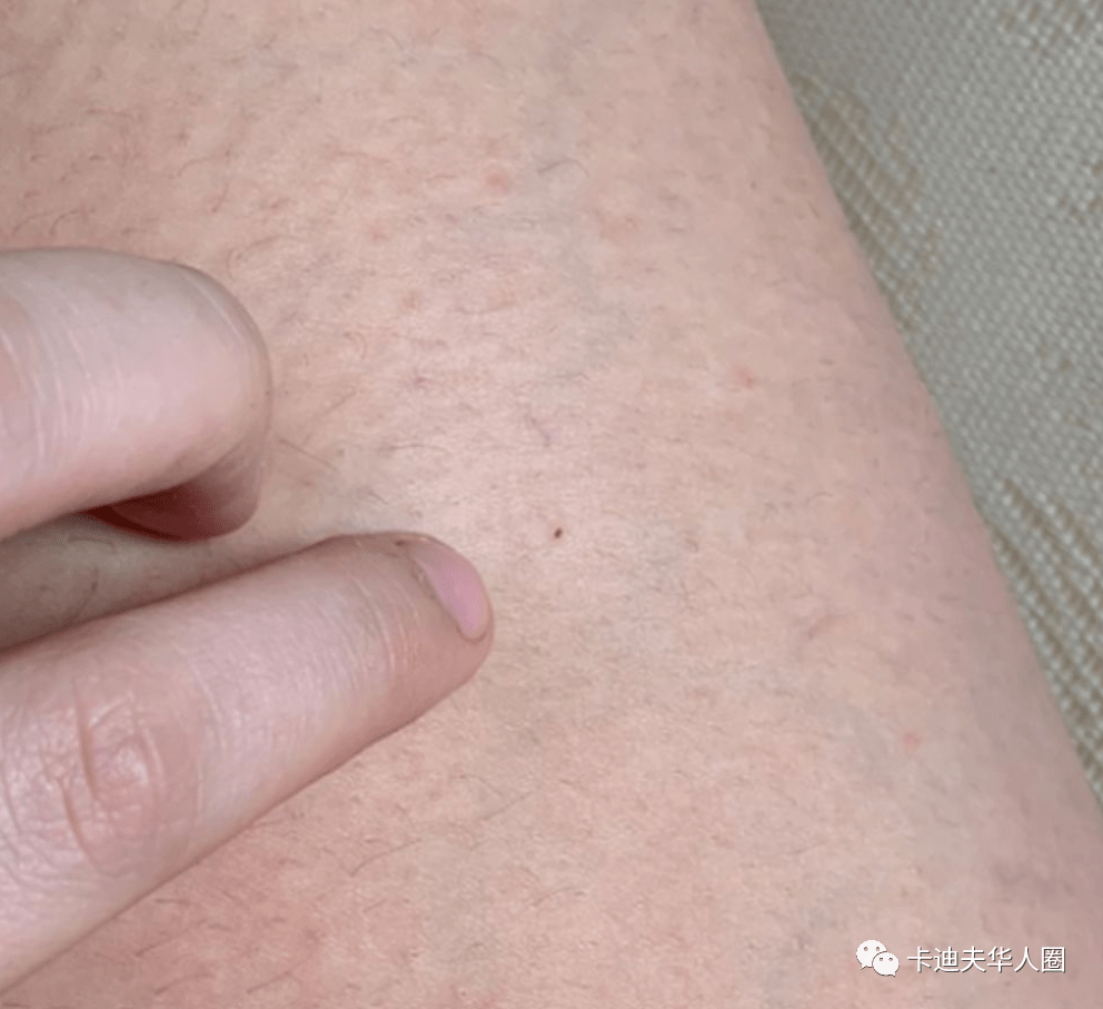 非常危险英国多地发生多起夜店遭遇针刺针头注射不明液体袭击案受害人