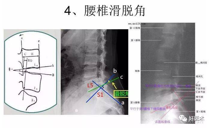 骨科常用的角度测量方法汇总全在这里了
