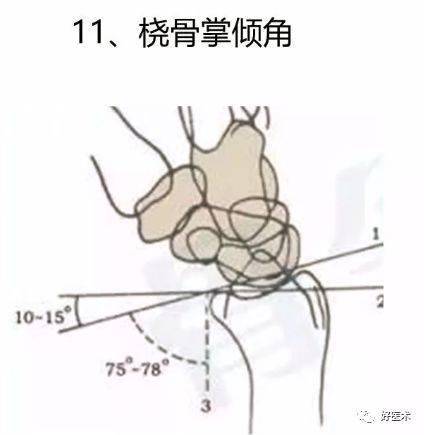 参考意义:如果teardrop角下降到45°以下,提示月骨关节面掌侧边缘向背