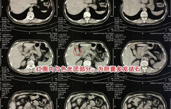 功能|女子反复腹痛7天就医，手术取出两颗“骰子”结石