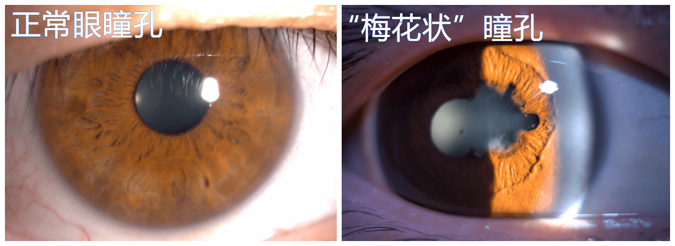 瞳孔几成一朵梅花患上了棘手的致盲性眼病葡萄膜炎
