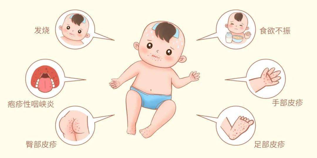 健康科普疱疹性咽峡炎进入高发期如何防治看这里