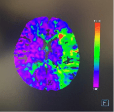 脑血管|18岁年轻小伙突发脑中风 广医三院开辟绿色通道与时间赛跑