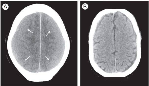 进行|脑出血CT的9大“陷阱”，稍不留神就会误诊