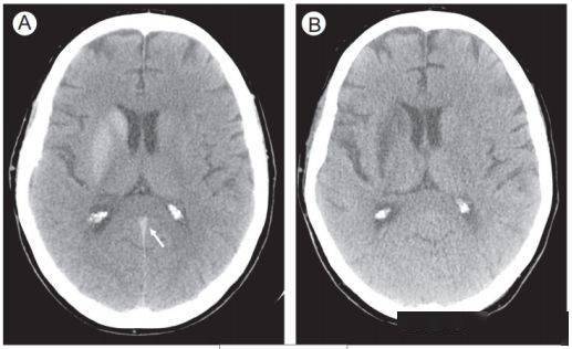 进行|脑出血CT的9大“陷阱”，稍不留神就会误诊