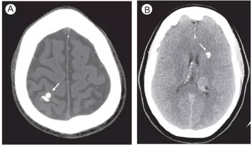 进行|脑出血CT的9大“陷阱”，稍不留神就会误诊