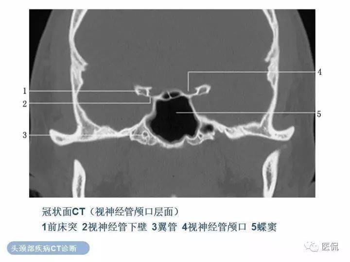 正常眼眶的ct解剖