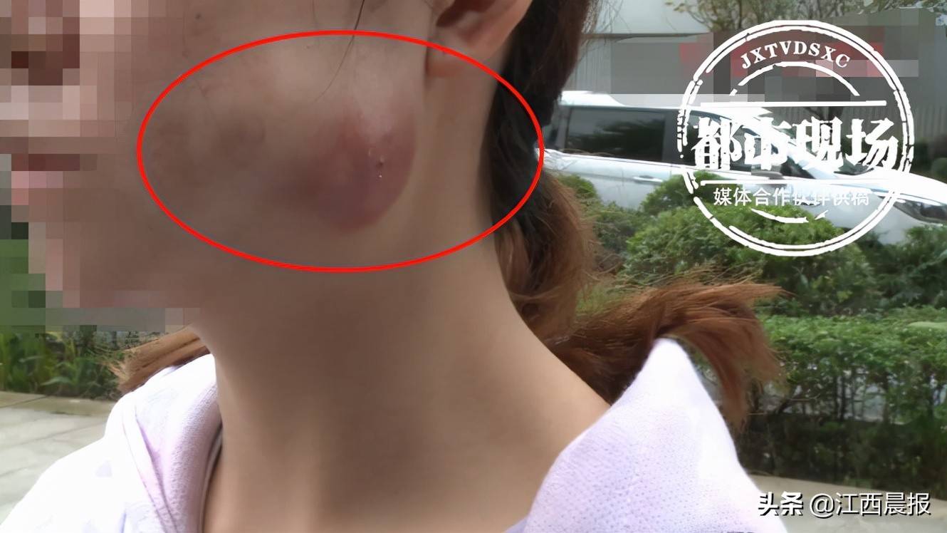 女子花万元注射玻尿酸脸上长出大肿块玛恩医疗美容医院被投诉