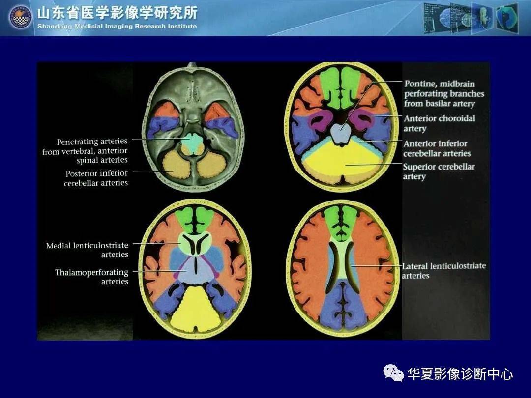 诊断|缺血性脑血管病的影像诊断