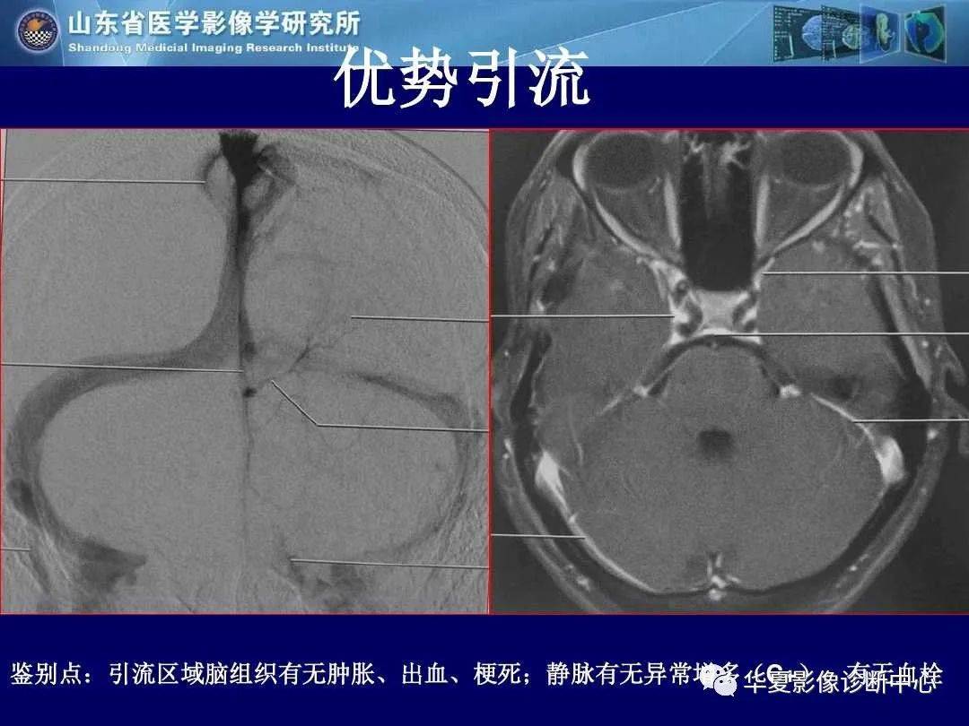 诊断|缺血性脑血管病的影像诊断