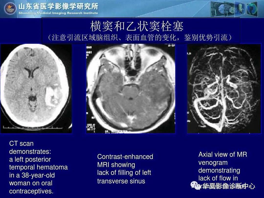 诊断|缺血性脑血管病的影像诊断