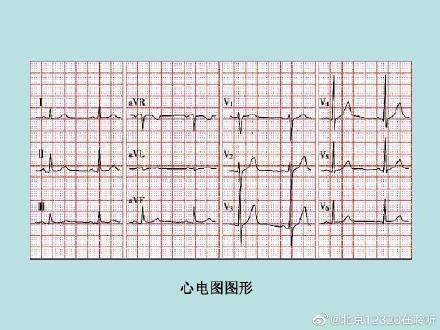 动态|如何读懂心电图？