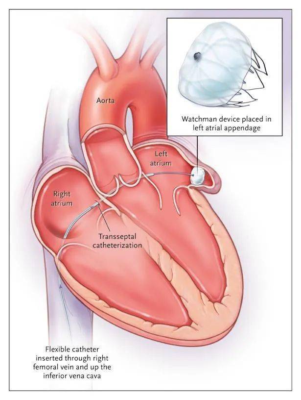 心律|【金沙讲坛】危险的“心动”——房颤