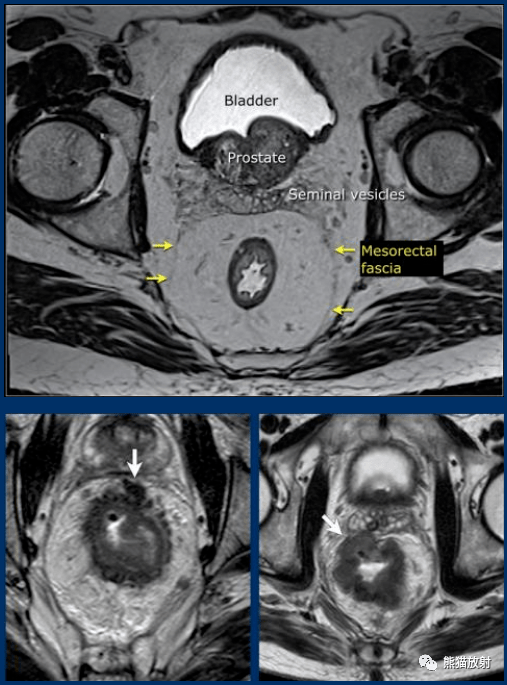 peritoneal cavity图片