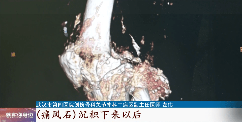 男子|被“石头”啃掉膝关节，男子几乎无法直立行走