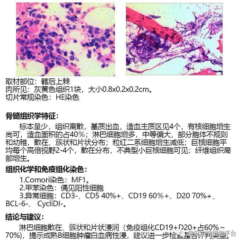 淋巴癌的报告单图片图片