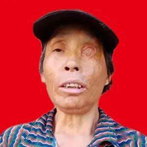 钟生月在4个月大时,因火灾失去了一双手掌和一只眼睛,成为重度残疾人.