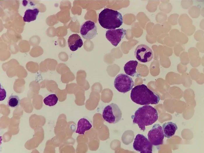 弥漫大B细胞淋巴瘤图片