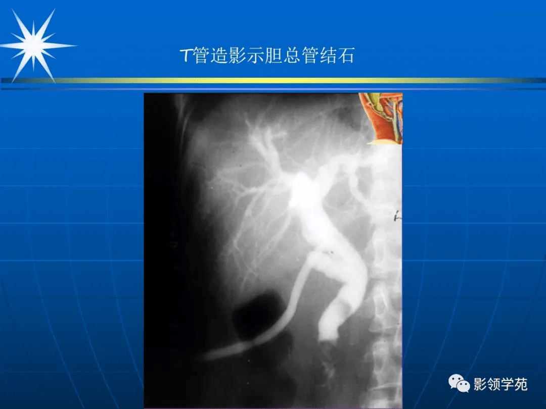 mri:t1wi和t2wi均呈低或無信號肝門區膽管癌手術後病理結果為膽總管下