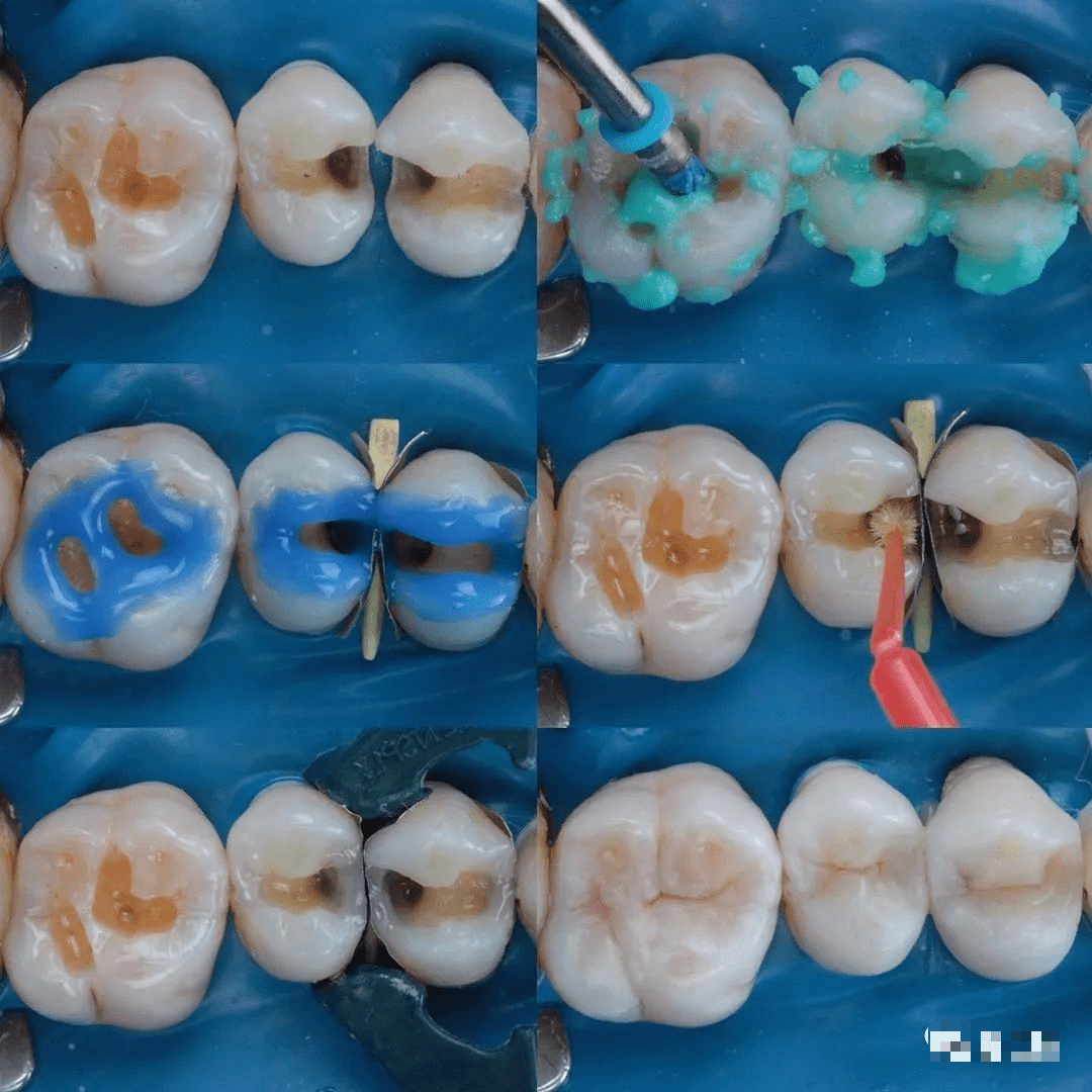 树脂补牙全过程图片图片