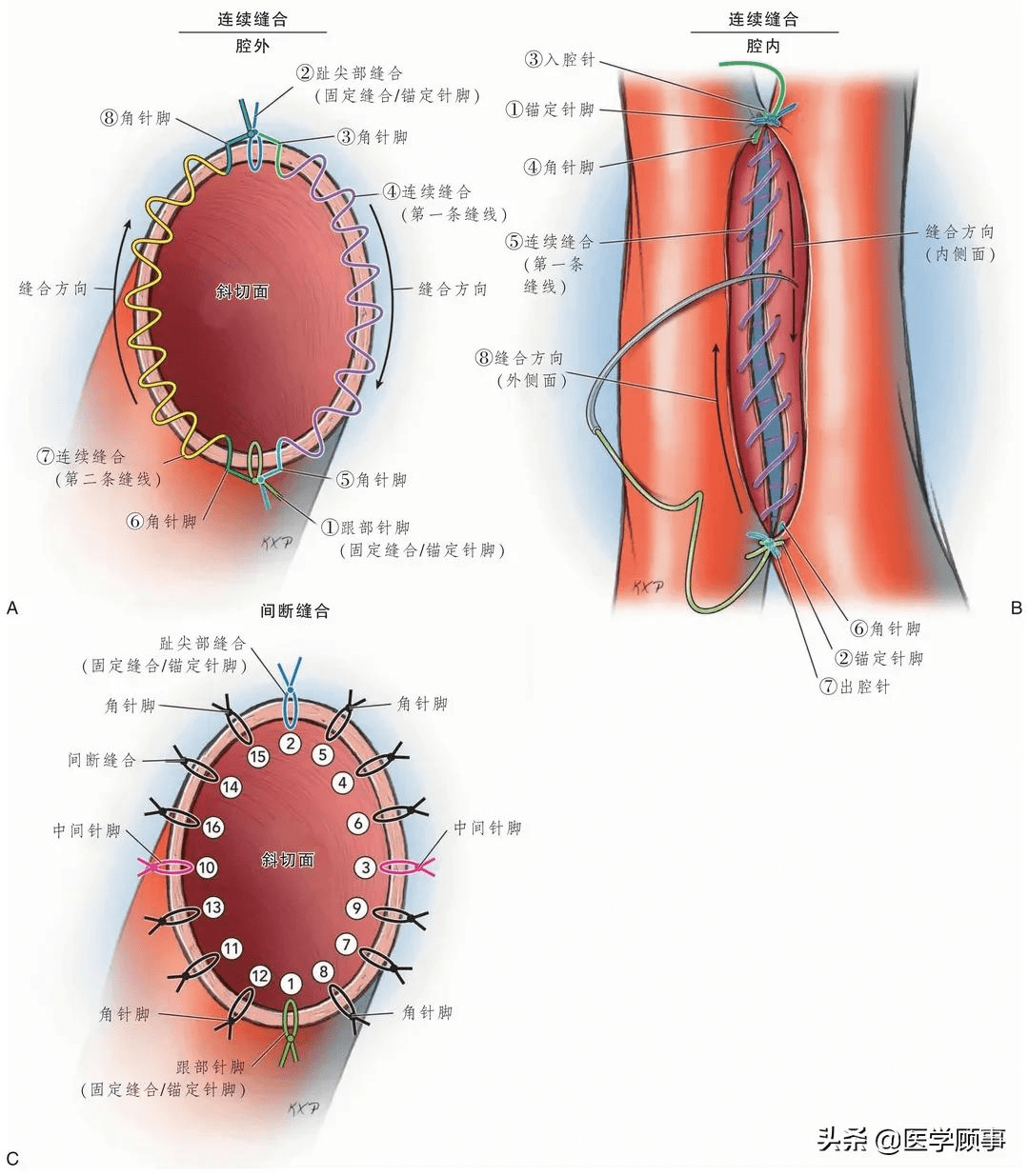 血管吻合缝合方法图片