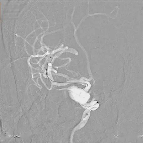 精准治疗pipeline64flex血流导向密网支架手术录播病例